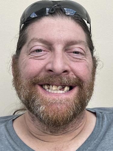 Patient smile before dental implant treatment, case 2