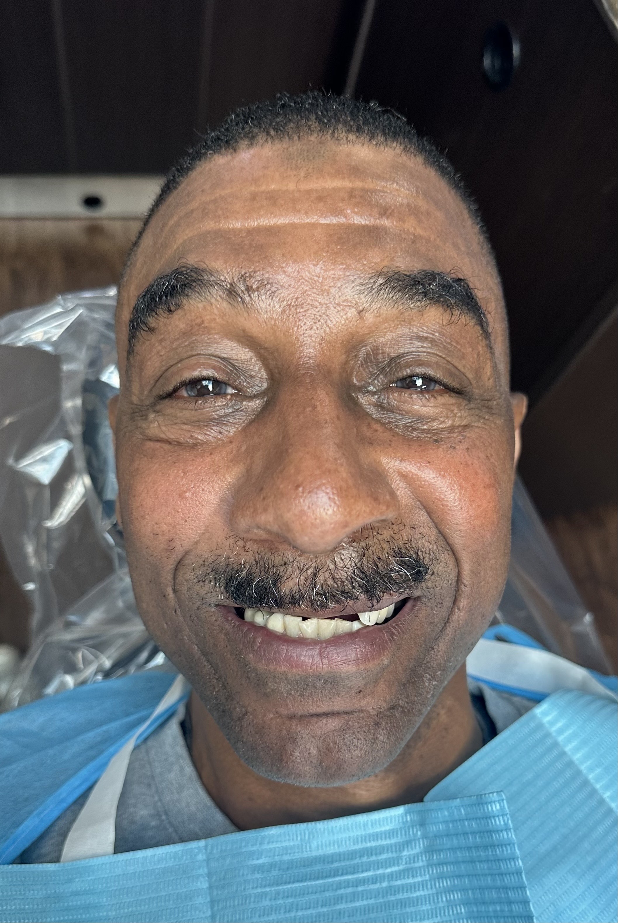Patient smile before dental implant treatment, case 3