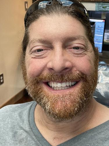 Patient smile after dental implant treatment, case 2